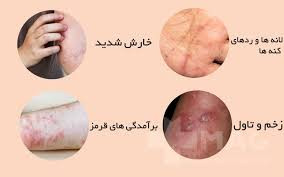 کرم ویتامین e و الوعه ورا برند ویتابلا خارجی درمان بیماری گال دوره دوماهه دوعدد کرم ترمیم کننده و محافظ پوست